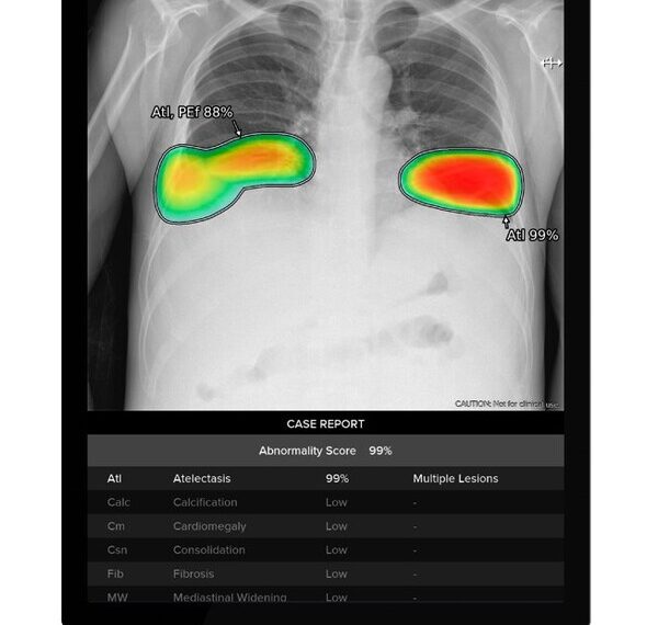 Lunit s AI powered chest X ray analysis solution Lunit INSIGHT CXR