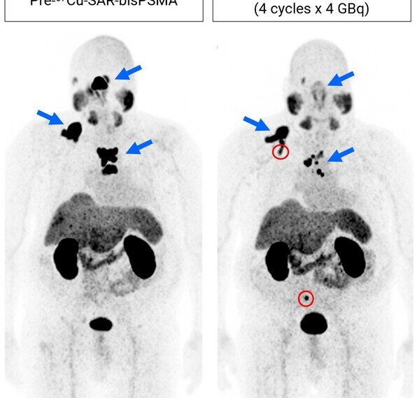 Images show considerable reduction lesion uptake 64Cu SAR bisPSMA PET 4 doses